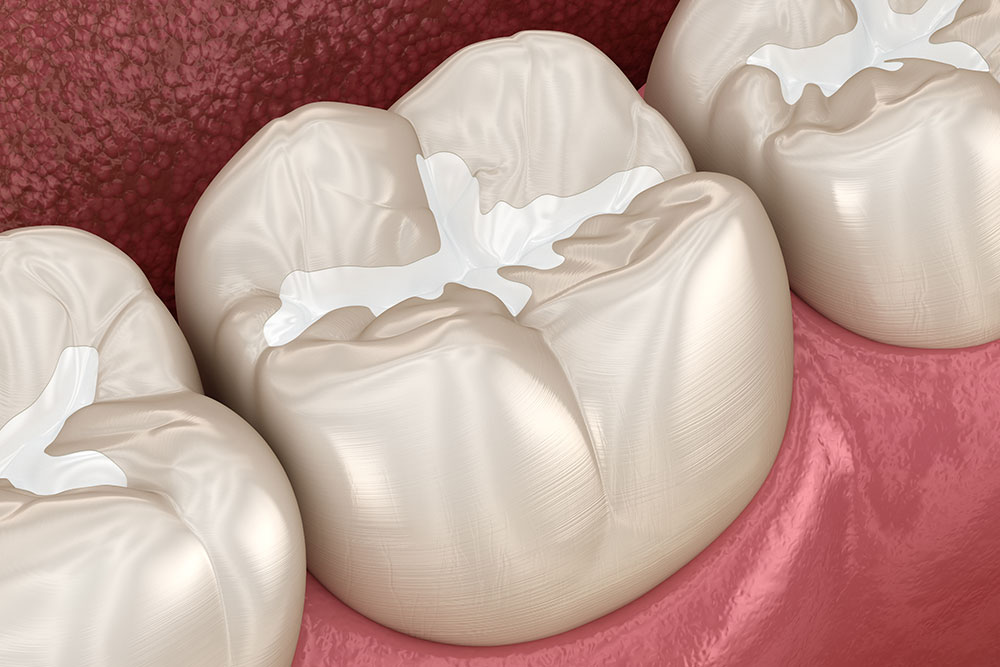 Composite Fillings