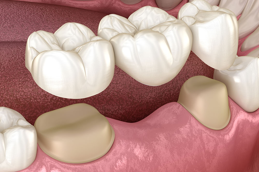 Dental Bridges