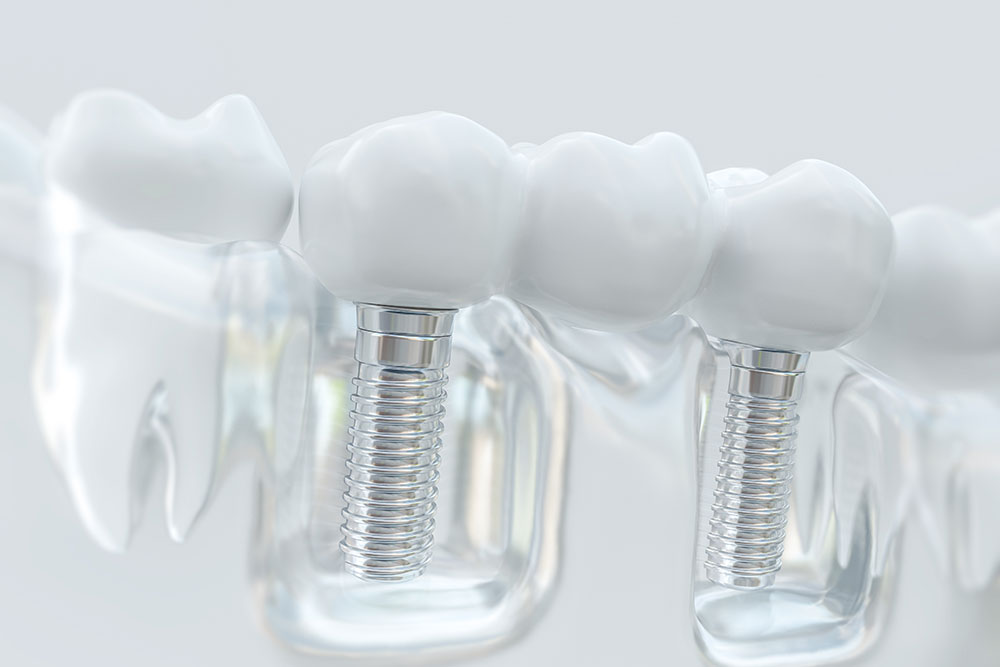 Implant Restoration