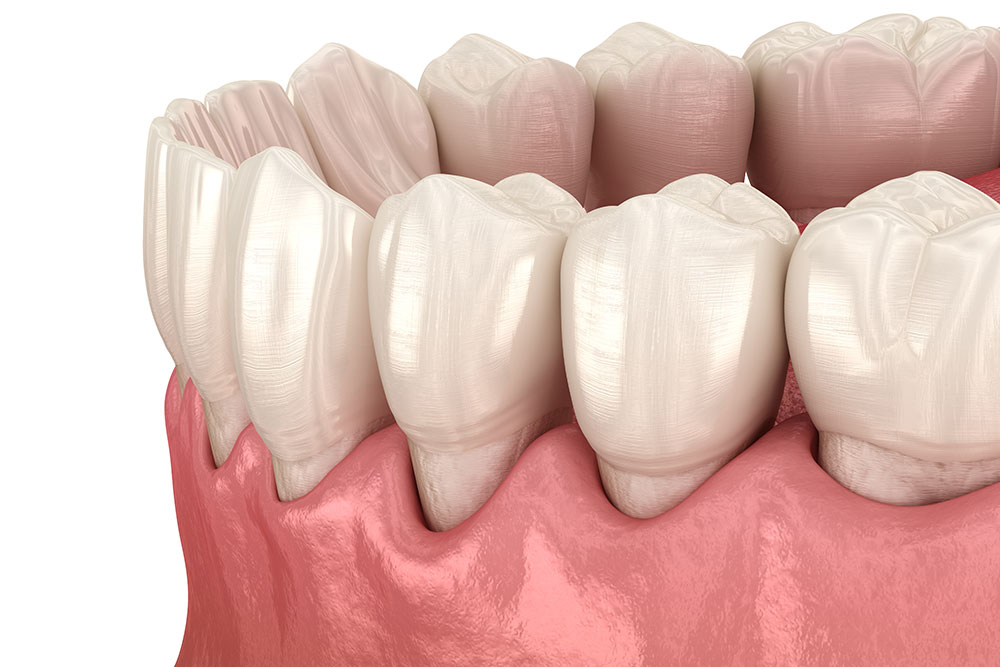 Periodontal Disease